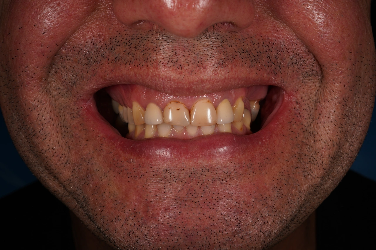 Dentadura en primer plano antes del tratamiento