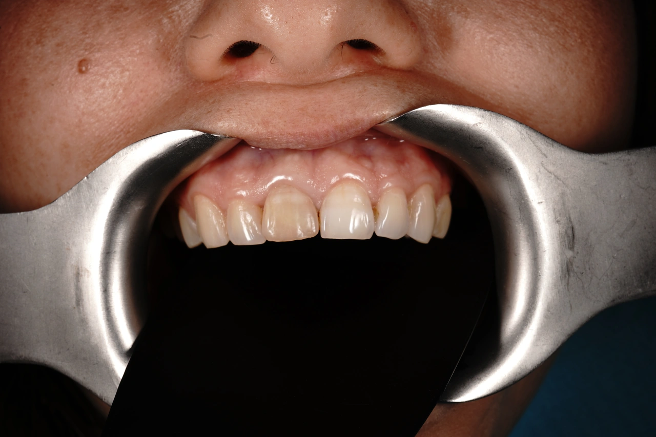 Sonrisa antes del blanqueamiento dental
